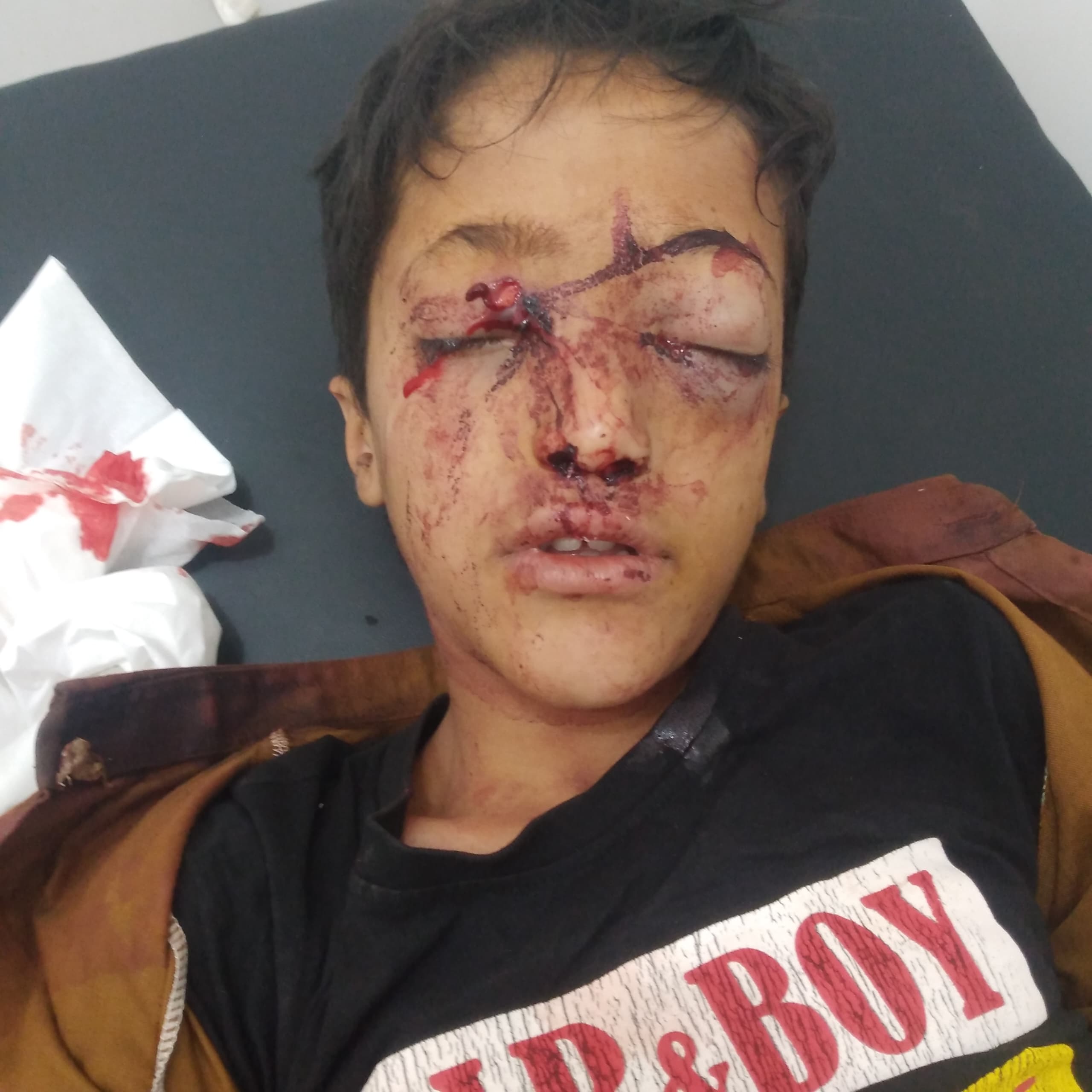قناص حوثي يصيب طفلاً في وجهه جنوب شرق تعز