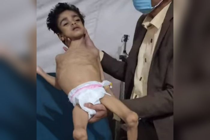 صورة من حجة توثق مأساة طفل أرهقه الجوع بفعل سياسة التجويع الحوثية