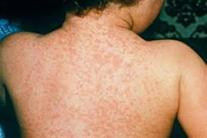 تعز تسجل 8 وفيات و819 إصابة بالحصبة والسلطات تدعو لتطعيم عاجل