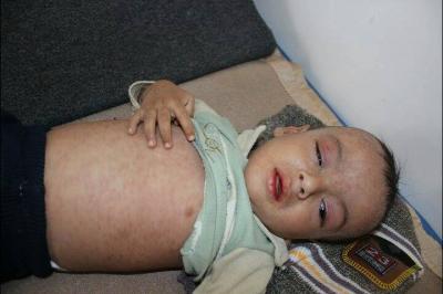 الأمم المتحدة: تصاعد حالات الحصبة في اليمن ينذر بكارثة صحية للأطفال