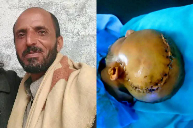 اعتداء جماعي يودي بشاب إلى العناية المركزة في ذمار ومطالبات بملاحقة الجناة (صورة)