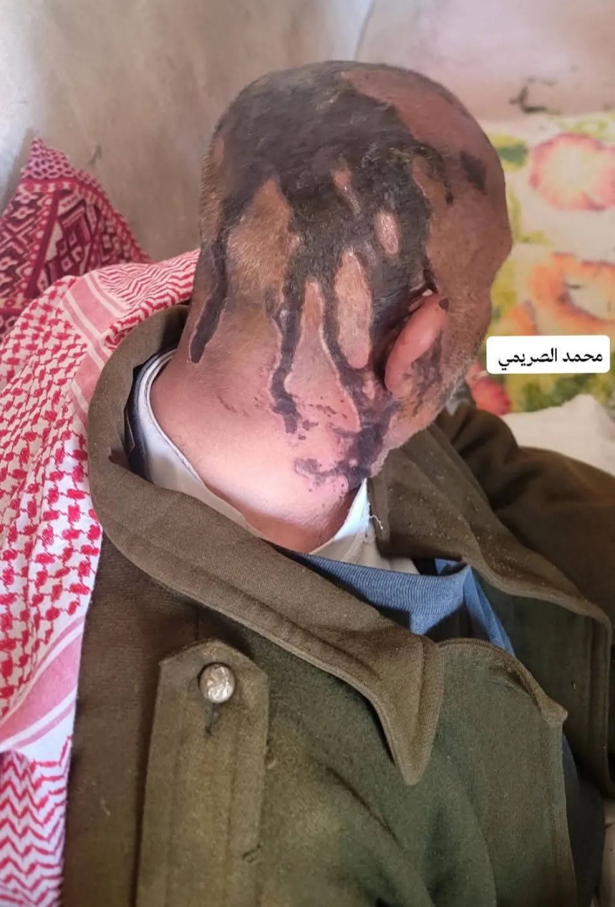 شبح العنف الأسري.. شابان يعتديان على والدهما بالأسيد في عمران