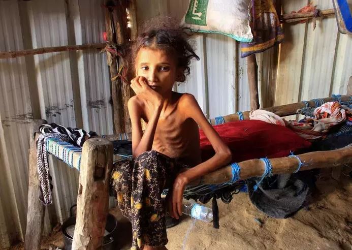 تقرير أممي: 83% من سكان اليمن في مناطق نفوذ الحكومة الشرعية يعانون من الفقر